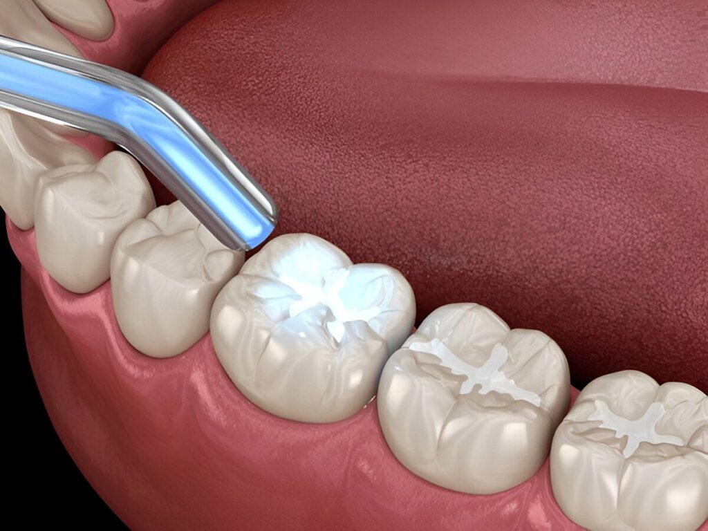 dental fillings near you