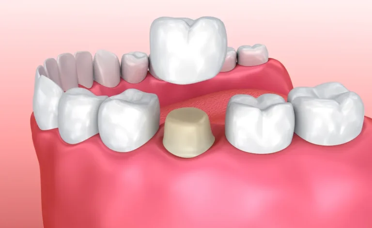lost or loose fillings crowns near you