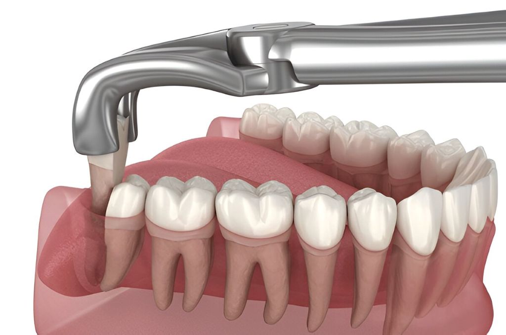 tooth extractions in garneau edmonton