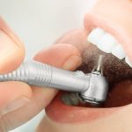 how teeth cleaning helps prevent tooth decay and bad breath