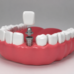 Dental Implant Recovery Mistakes You Must Avoid for a Successful Outcome