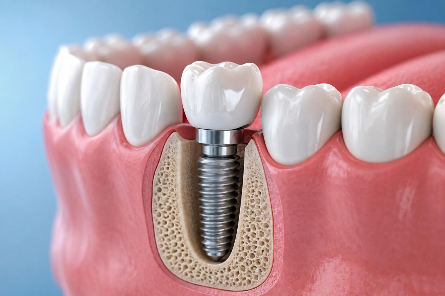 How dental implants work step by step process