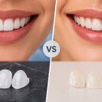 Which Is Better—Composite or Porcelain Veneers